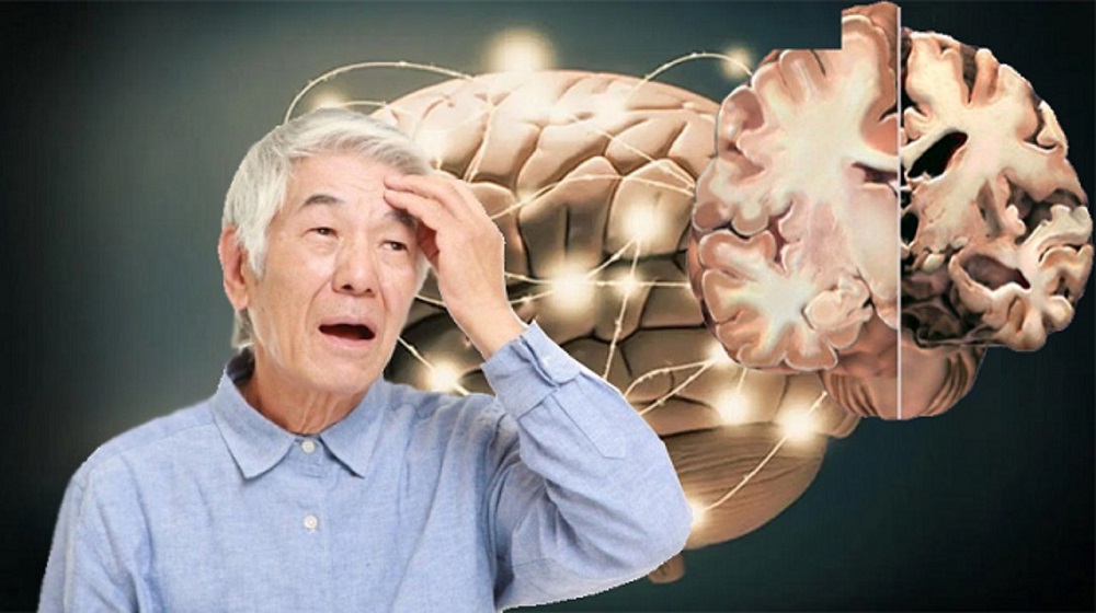 Nguyên nhân của bệnh Alzheimer