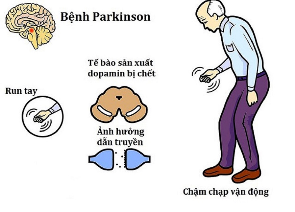 Thế nào là bệnh Parkinson?
