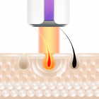  Máy triệt lông Yamaguchi IPL Hair Removal